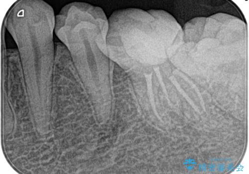 昨晩から激痛。精密根管治療の治療後