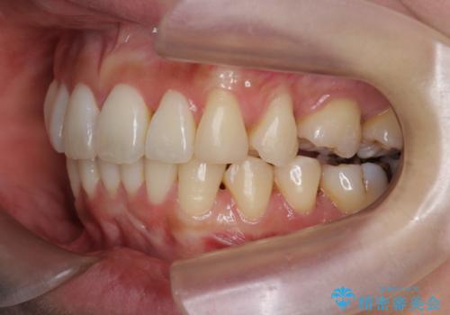 [[ インビザライン ライト ]]  下がってしまった歯ぐきを元に戻したいの治療後