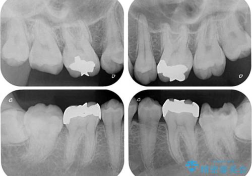 深い咬み合わせと奥歯のむし歯 総合歯科治療の治療前