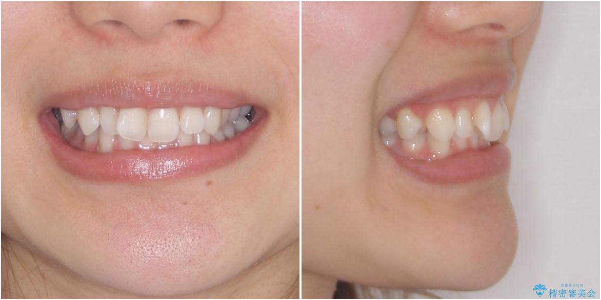 深い咬み合わせと奥歯のむし歯　総合歯科治療の治療前（顔貌）