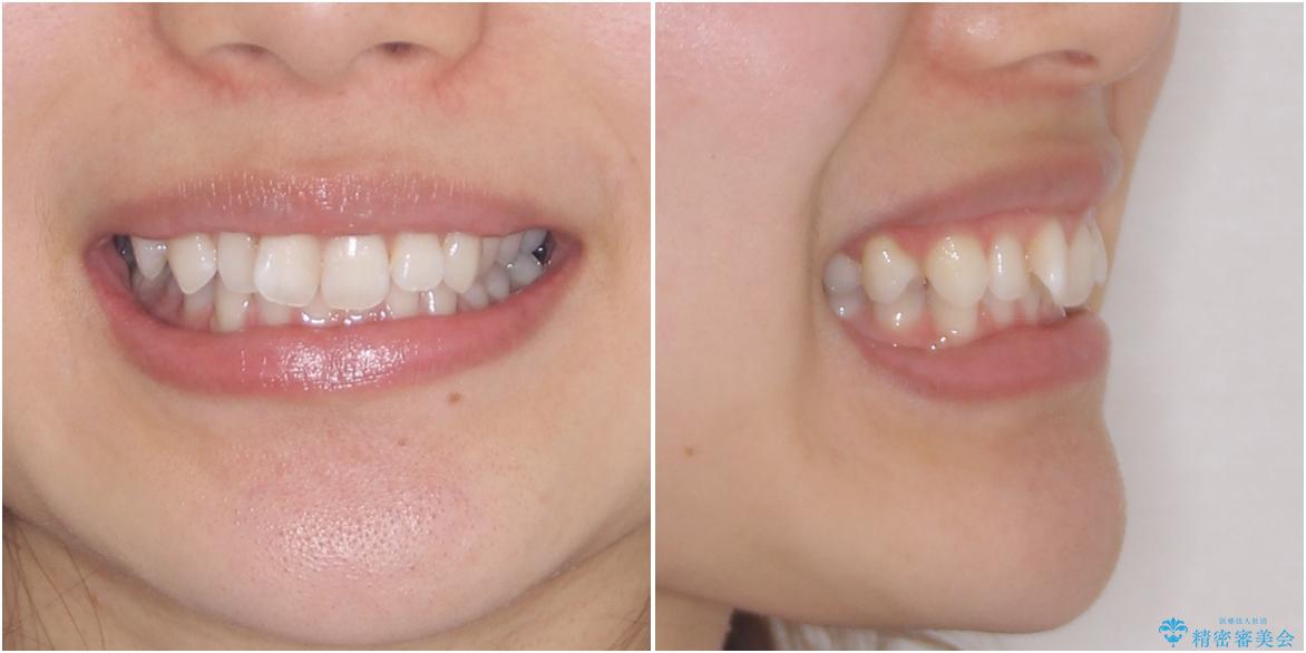 深い咬み合わせと奥歯のむし歯 総合歯科治療の治療前(顔貌)