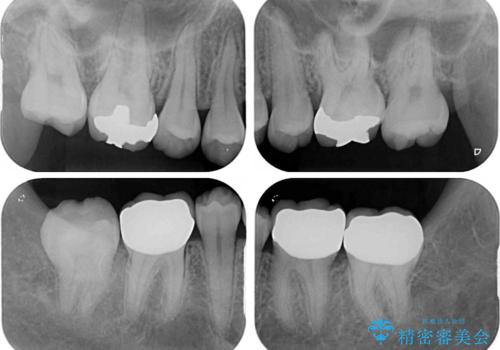 深い咬み合わせと奥歯のむし歯 総合歯科治療の治療後