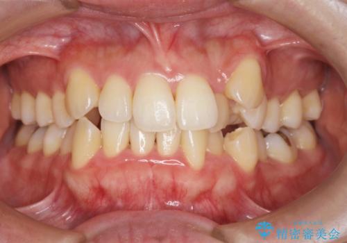 [ 八重歯 ] マウスピース部分矯正による改善の治療前