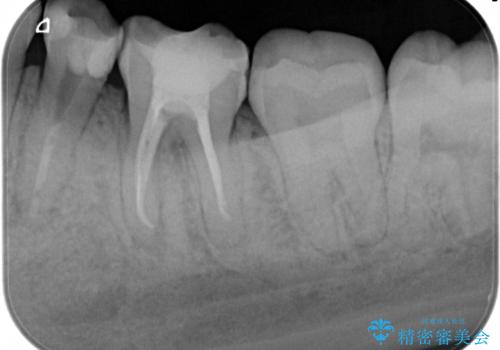 精密根管治療。大臼歯イニシャルケースの治療後