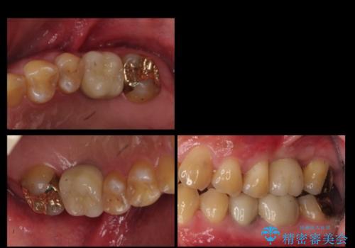 上の奥歯のインプラント、全体的な虫歯治療の治療後
