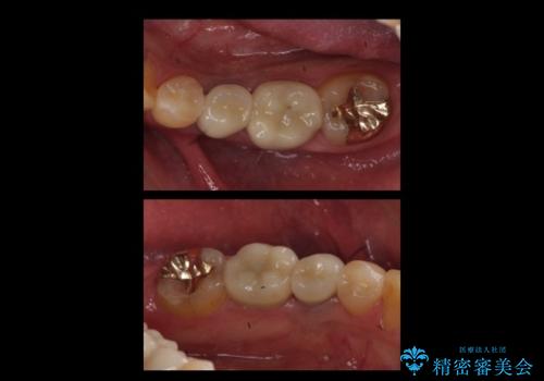 上の奥歯のインプラント、全体的な虫歯治療の治療後