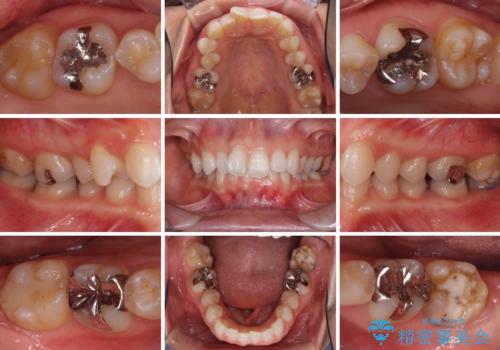 深い咬み合わせと奥歯のむし歯 総合歯科治療の治療前