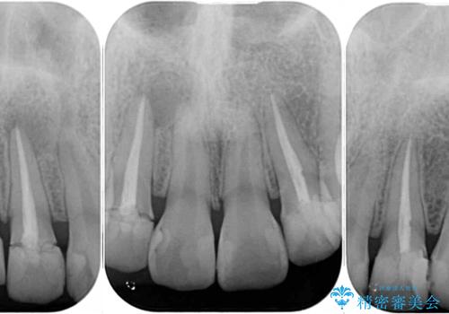 継ぎ接ぎだらけの前歯を綺麗にしたい 前歯のオールセラミックの治療前