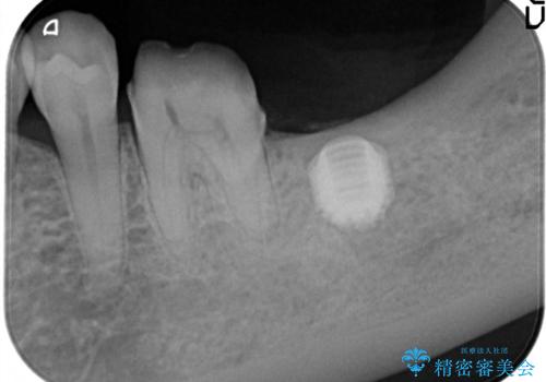 失った歯のインプラントでの咬合回復の治療中