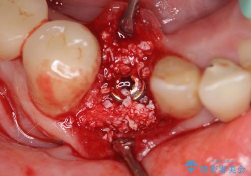 吸収した骨の再生　前歯部インプラント治療の治療中