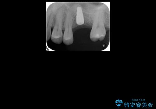 上の奥歯のインプラント、全体的な虫歯治療の治療中