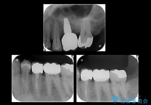 上の奥歯のインプラント、全体的な虫歯治療の治療後