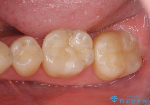 見える銀歯を白くの症例 治療後