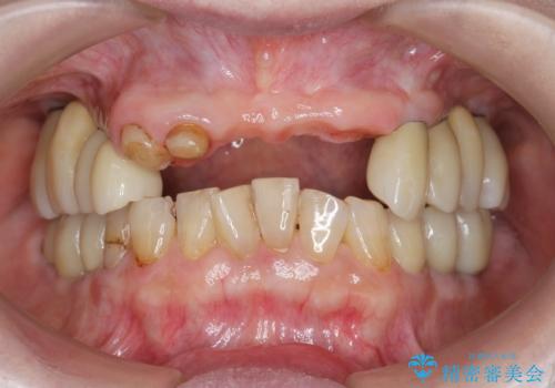 [[ 上顎多数歯欠損 ]]   インプラント・義歯を用いた補綴の治療中