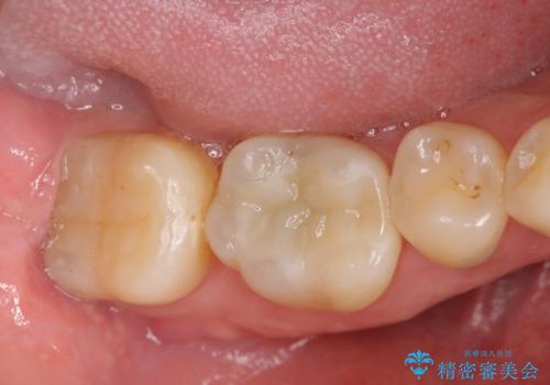 笑った時に見える銀歯を白くしたいの治療後