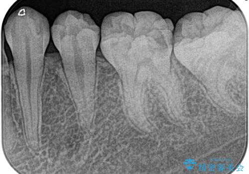 昨晩から激痛。精密根管治療の治療前