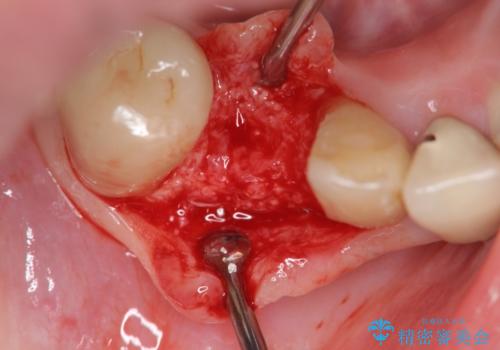 吸収した骨の再生 前歯部インプラント治療の治療中