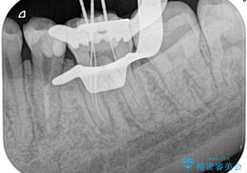 精密根管治療。大臼歯イニシャルケースの治療中