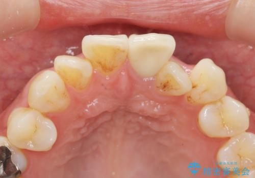 歯の変色　前歯の審美改善の治療後