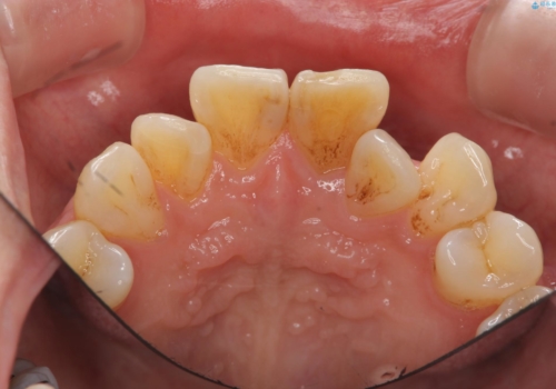 歯の変色 前歯の審美改善の治療前