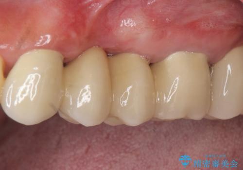 歯周病　側方力に対抗するブリッジ補綴の治療後