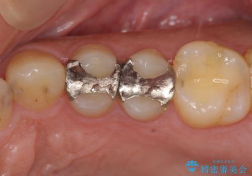 近所で入れた銀歯に食べ物が挟まるの治療前
