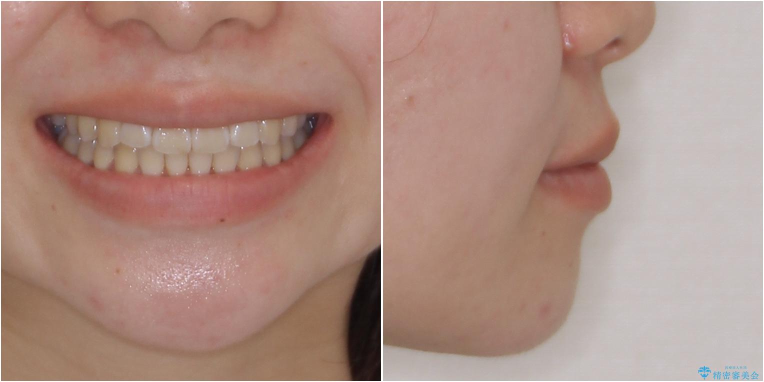 海外留学をしながら歯並びを整えたい インビザラインによる矯正治療の治療後(顔貌)