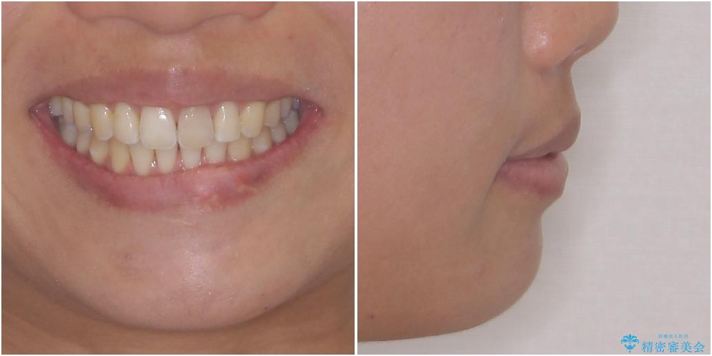 気になる前歯を治したい　インビザライン矯正とオールセラミッククラウンの治療後（顔貌）