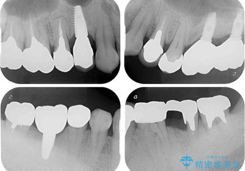 折れてしまった奥歯 インプラントによる補綴治療の治療後