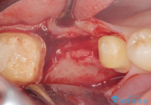 臼歯インプラント補綴の治療中