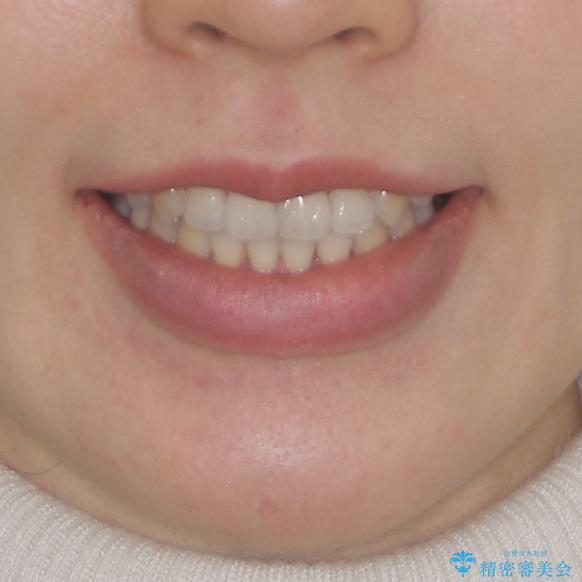 前歯のデコボコを治したい ワイヤー矯正の治療後(顔貌)