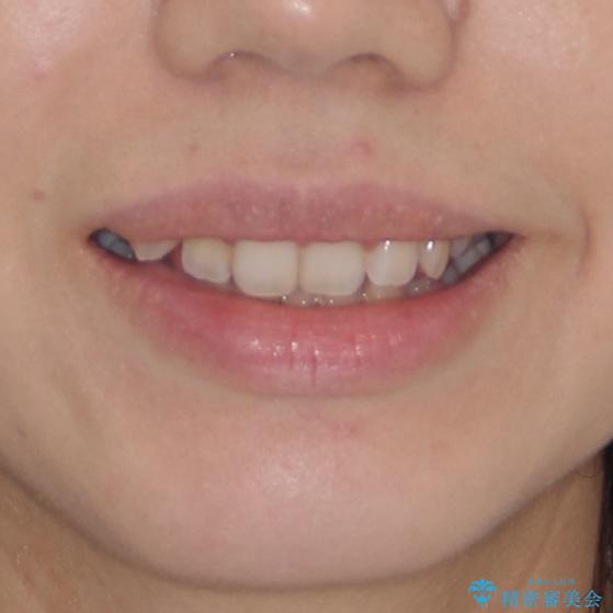 気になる八重歯を治したい　インビザラインと補助装置を用いた抜歯治療の治療前（顔貌）