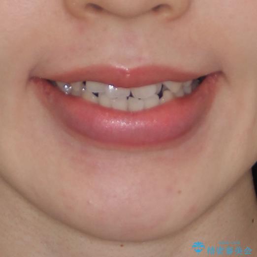 前歯のデコボコを治したい ワイヤー矯正の治療前(顔貌)