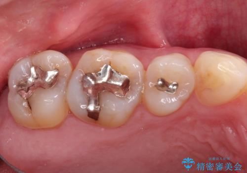 メタルフリーの治療 メタルインレーからセラミックインレーへの治療前