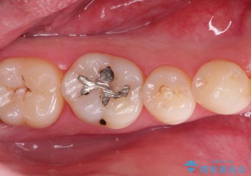 メタルフリーの治療 セラミックインレー の症例 治療前