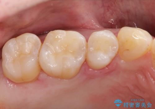 メタルフリーの治療 メタルインレーからセラミックインレーへの治療後