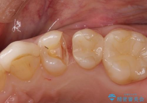 虫歯の治療(セラミックインレー)の治療中