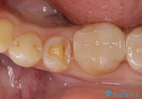 虫歯の治療(セラミックインレー)の治療中