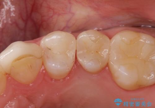 虫歯の治療(セラミックインレー)の症例 治療後