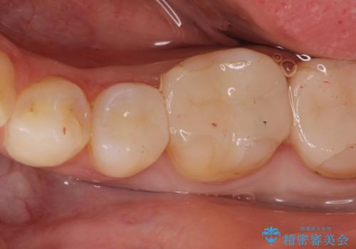 虫歯の治療(セラミックインレー)の治療後