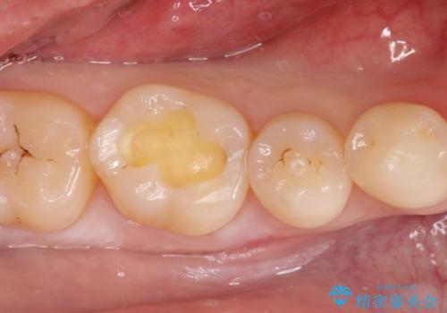 メタルフリーの治療 セラミックインレー の治療中