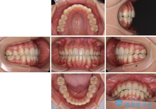 【モニター】 インビザラインによる後戻りの再矯正治療の治療後