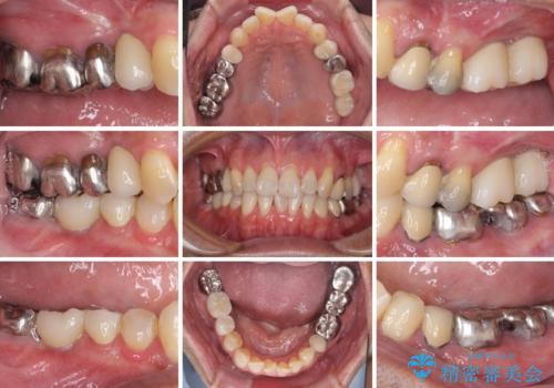 折れてしまった奥歯 インプラントによる補綴治療の治療後