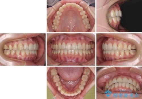 海外留学をしながら歯並びを整えたい インビザラインによる矯正治療の治療後