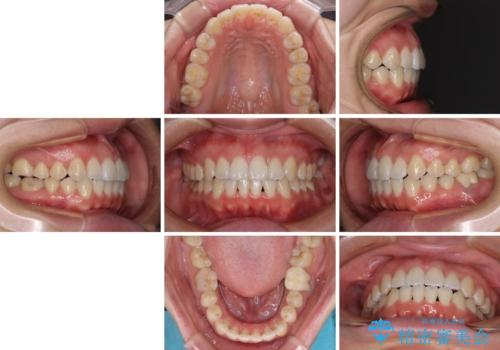 前歯のデコボコを治したい ワイヤー矯正の治療後