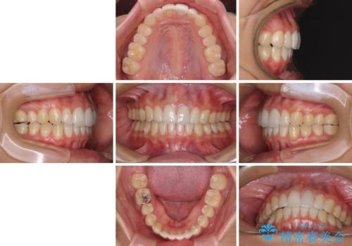 気になる前歯を治したい インビザライン矯正とオールセラミッククラウンの治療後