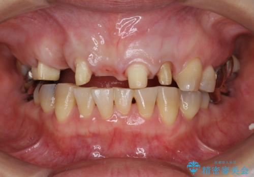 過度な咬合力　歯ぎしりで抜けた歯の欠損補綴の治療中