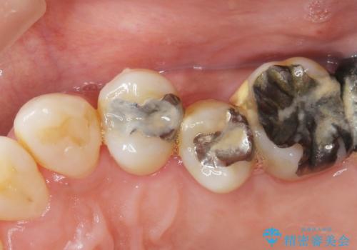 歯周病　側方力に対抗するブリッジ補綴の治療前
