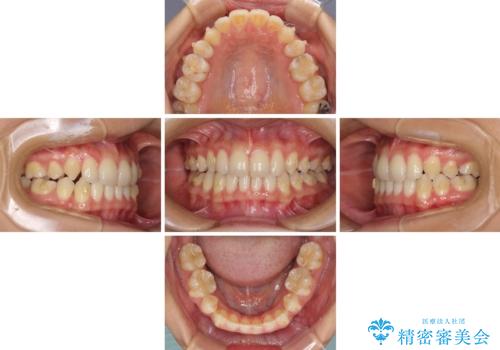 抜歯矯正の後戻りによるすきっ歯をインビザラインでの治療中