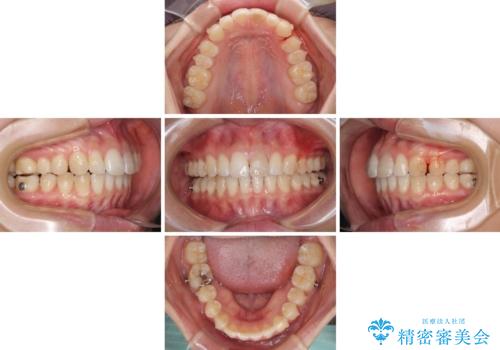 気になる前歯を治したい インビザライン矯正とオールセラミッククラウンの治療中